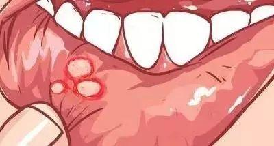 口腔溃疡小妙招，有效缓解口腔溃疡的小妙招有哪些（口腔溃疡没完没了）