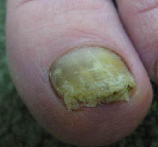 指甲盖各种疾病图片图片
