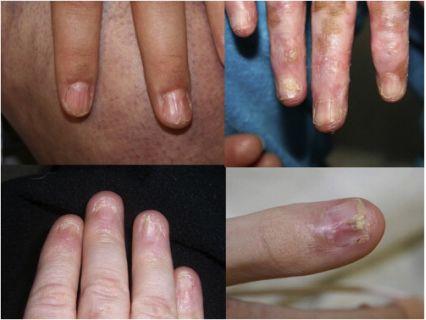 手指甲疾病种类图片图片