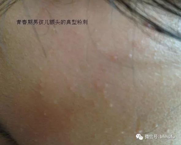 粉刺和闭口的区别，你知道吗，“闭口”也分很多种