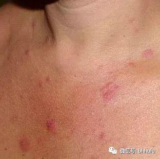 粉刺和闭口的区别，你知道吗，“闭口”也分很多种