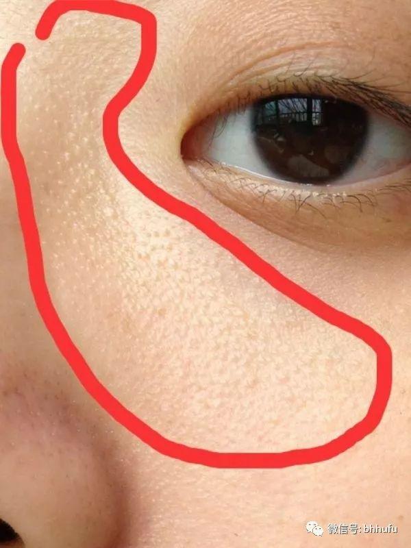 粉刺和闭口的区别，你知道吗，“闭口”也分很多种