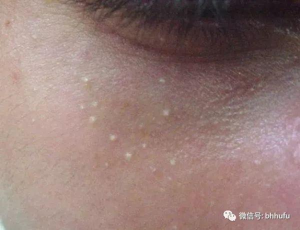 粉刺和闭口的区别，你知道吗，“闭口”也分很多种