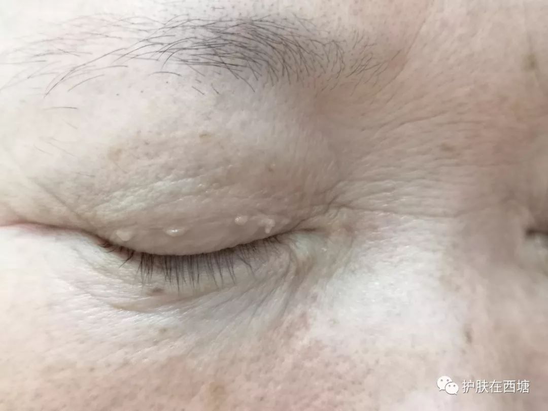 常见面部皮肤病科普(七):汗管瘤