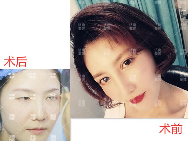 做双眼皮好吗，女生来例假前做双眼皮好吗（妹子仅仅做了双眼皮）