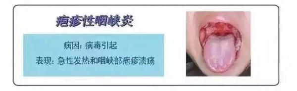 疱疹性咽峡炎吃什么药，宝宝得疱疹性咽峡炎吃什么药啊（貌似手足口同样易中招）