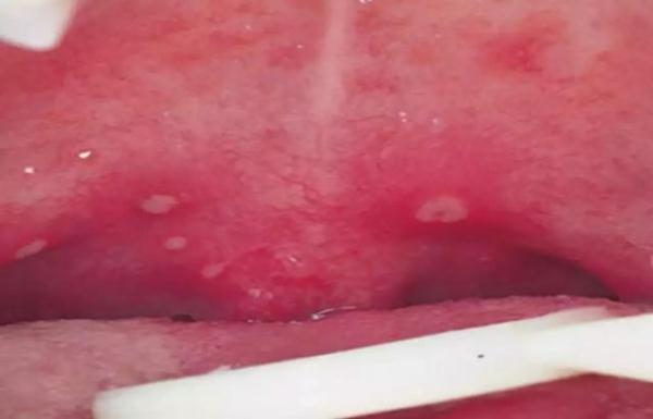 疱疹性咽峡炎吃什么药，宝宝得疱疹性咽峡炎吃什么药啊（貌似手足口同样易中招）