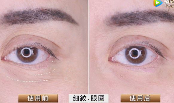 胶原蛋白对眼部皱纹有效吗，口服胶原蛋白能改善眼部皱纹吗（细纹、松垂、色斑都搞定）