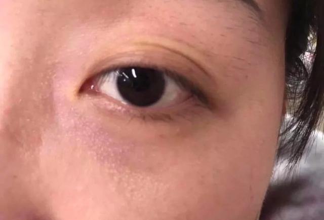 胶原蛋白对眼部皱纹有效吗，口服胶原蛋白能改善眼部皱纹吗（细纹、松垂、色斑都搞定）