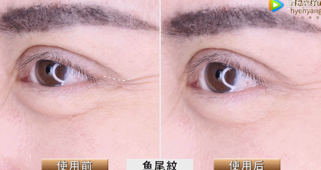 胶原蛋白对眼部皱纹有效吗，口服胶原蛋白能改善眼部皱纹吗（细纹、松垂、色斑都搞定）