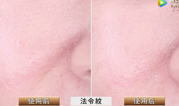 胶原蛋白对眼部皱纹有效吗，口服胶原蛋白能改善眼部皱纹吗（细纹、松垂、色斑都搞定）