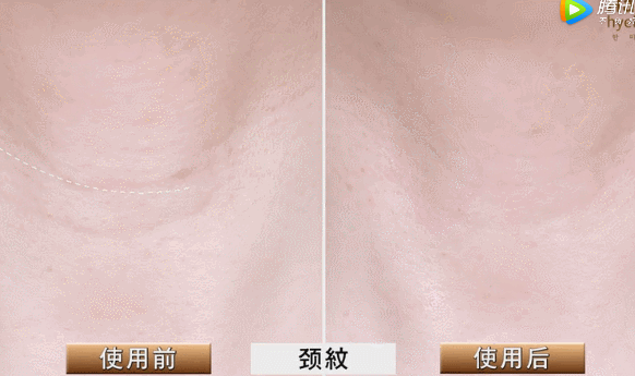 胶原蛋白对眼部皱纹有效吗，口服胶原蛋白能改善眼部皱纹吗（细纹、松垂、色斑都搞定）