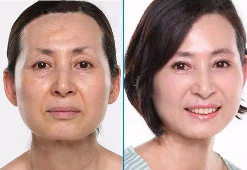 胶原蛋白对眼部皱纹有效吗，口服胶原蛋白能改善眼部皱纹吗（细纹、松垂、色斑都搞定）