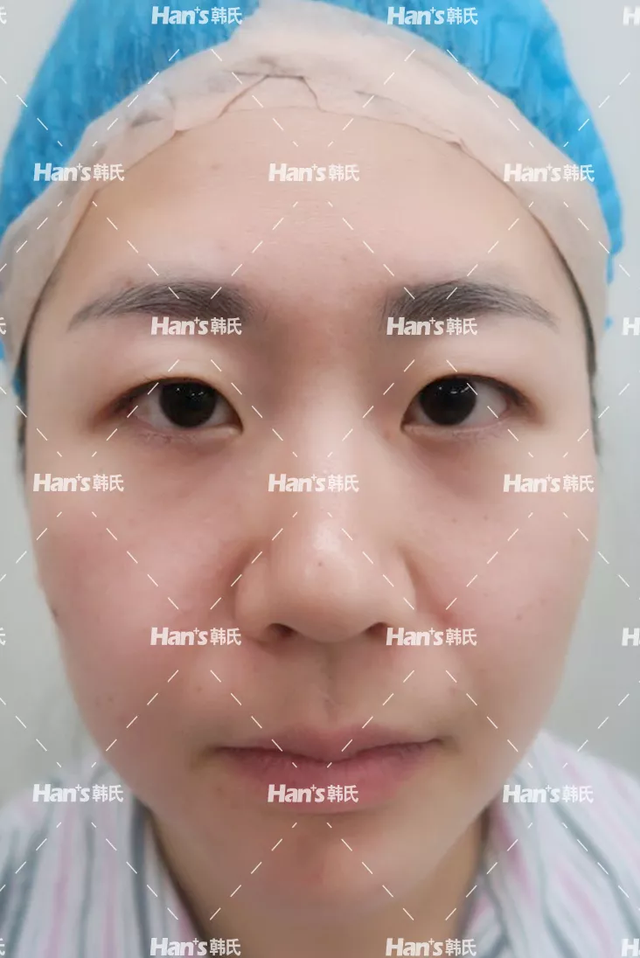 眼皮抽脂效果好吗，眼皮抽脂的好处（到底该去吸脂还是做双眼皮）