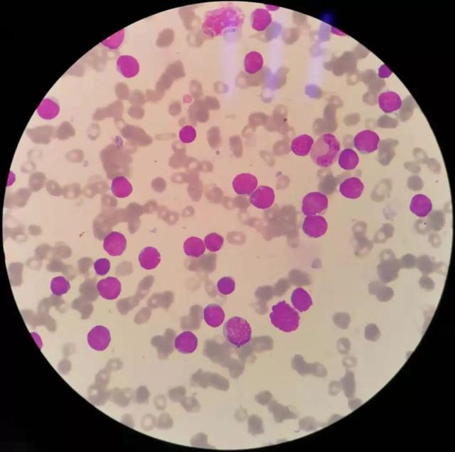 白细胞低多少是白血病,恢复血小板最好的方法(全血细胞减少到白血病