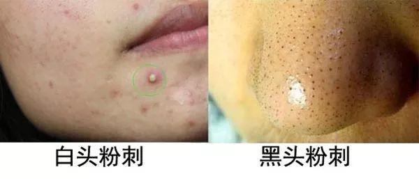 闭口和痘痘的区别，长痘痘和闭口的区别（其实并不相同....）