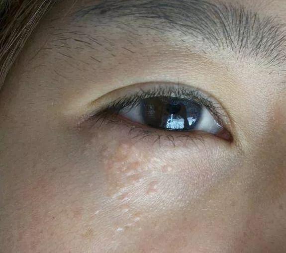 闭口和痘痘的区别，长痘痘和闭口的区别（其实并不相同....）