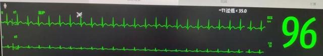  监护仪上的pr过高什么意思，ICU的床旁监护，你会看吗