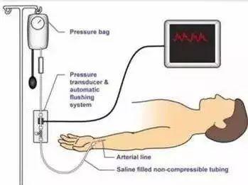 监护仪上的pr过高什么意思，ICU的床旁监护，你会看吗
