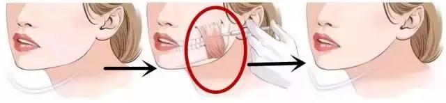 瘦脸针多久打一次，瘦脸针一般多久打一次（瘦脸针不再是娱乐圈的秘密）