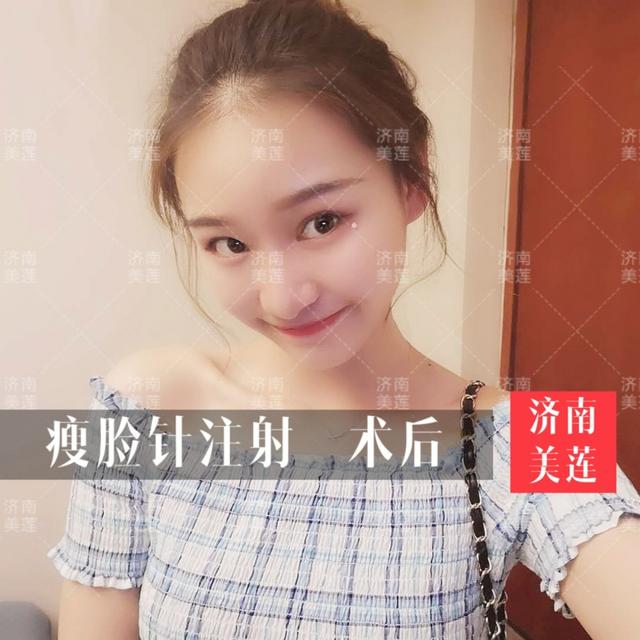 瘦脸针多久打一次，瘦脸针一般多久打一次（瘦脸针不再是娱乐圈的秘密）