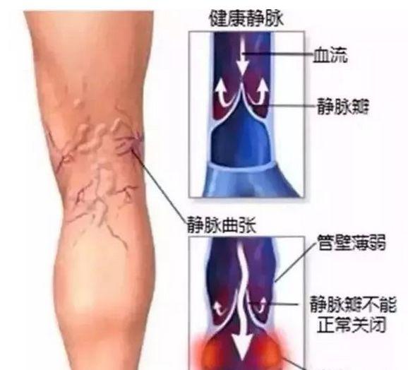 大腿皮肤表面触碰疼痛，皮肤表面轻微的触碰就疼怎么办（腿疼先别揉，当心血栓随血流）