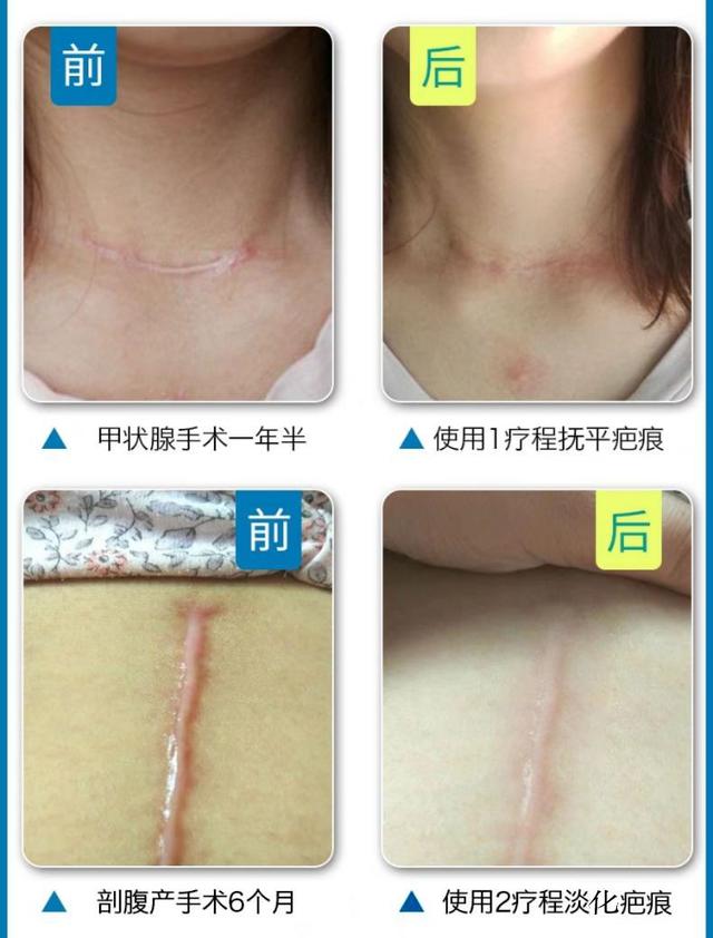 哪里可以祛疤，哪里可以祛疤痕的药膏（——厦门三院整形美容外科助您祛瘢无忧）