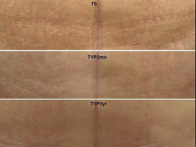 哪里可以祛疤，哪里可以祛疤痕的药膏（——厦门三院整形美容外科助您祛瘢无忧）