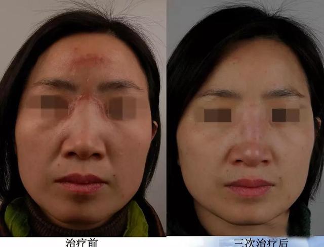 哪里可以祛疤，哪里可以祛疤痕的药膏（——厦门三院整形美容外科助您祛瘢无忧）