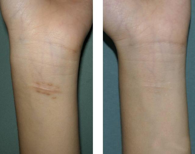 哪里可以祛疤，哪里可以祛疤痕的药膏（——厦门三院整形美容外科助您祛瘢无忧）