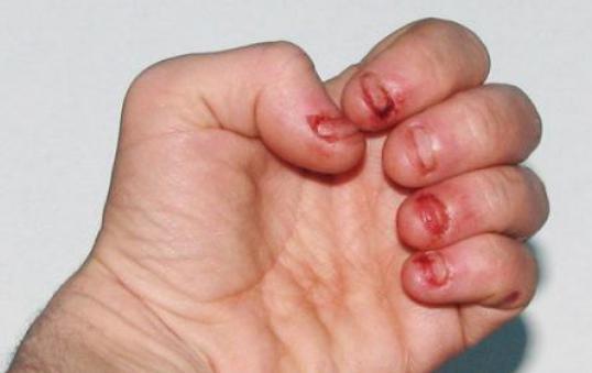 小孩子啃手指甲是什么原因，孩子经常咬手指和指甲是什么原因（孩子从小爱啃指甲，长大会如何）