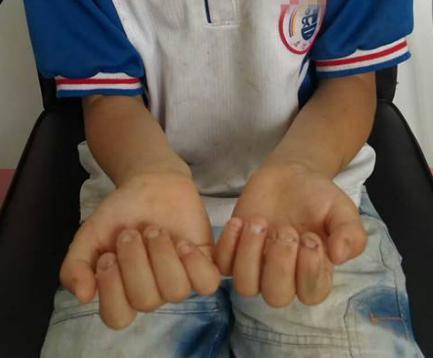 小孩子啃手指甲是什么原因，孩子经常咬手指和指甲是什么原因（孩子从小爱啃指甲，长大会如何）