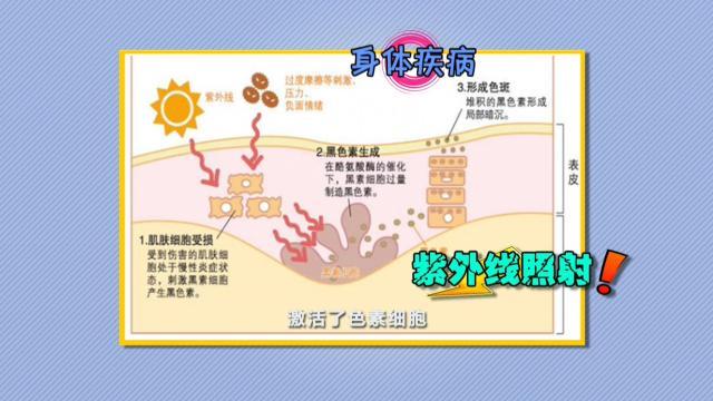 雀斑可以根除吗，遗传的雀斑能不能根除（激光能治愈黄褐斑？辟谣了）