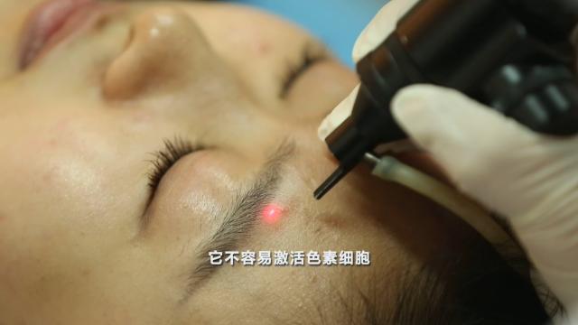 雀斑可以根除吗，遗传的雀斑能不能根除（激光能治愈黄褐斑？辟谣了）