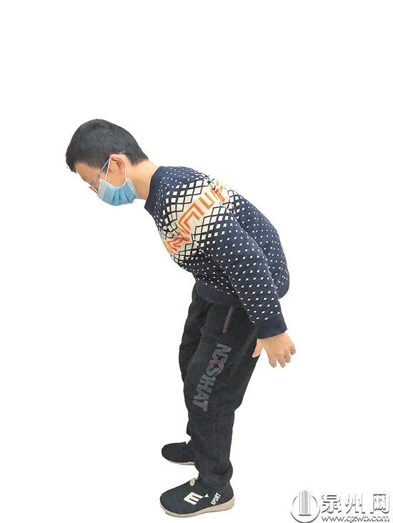 患强直性脊柱炎 男子驼背畸形 手术后弯了17年的腰直了