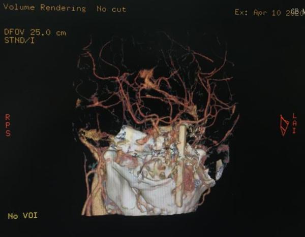 731部队活体解剖，731部队活体解剖打不打麻药（一男童摔倒筷子插入颅脑5厘米深）