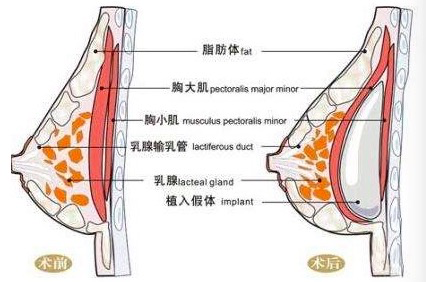 隆胸后多久可以同房，做完隆胸手术后多久可以同房（隆胸手感也是一门学问）