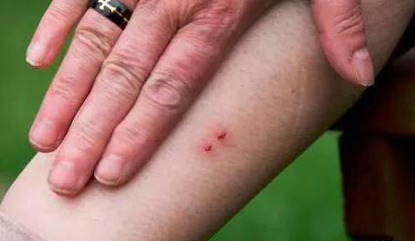 蜂子蛰了怎样处理，蜜蜂蛰了怎么处理好得快食用醋（外出游玩被蜂蛰、被蛇咬怎么办）