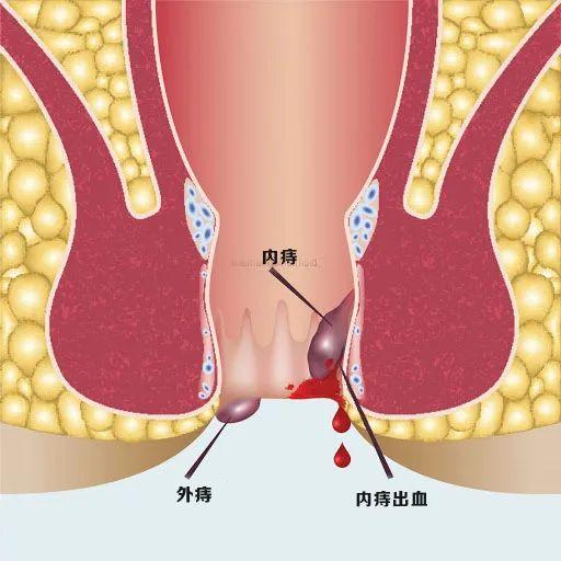 肛门正常与痔疮图片图片