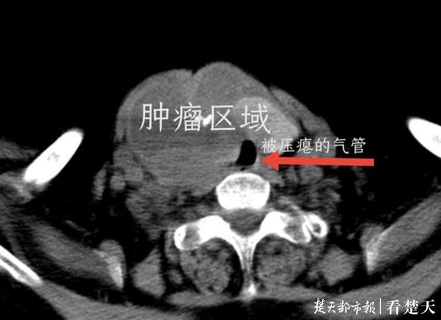 梦见被掐脖子快窒息惊醒了，梦见被掐脖子然后惊醒了是什么预示（婆婆反复梦到被人“掐脖子”）