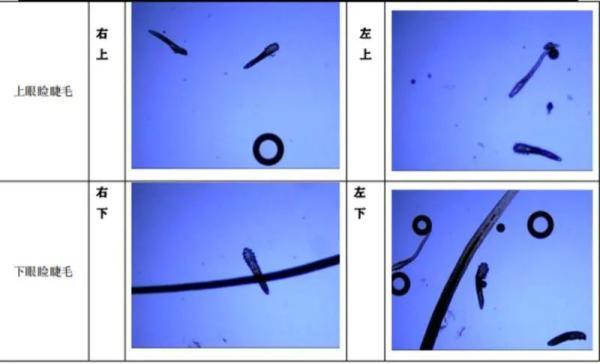 床上螨虫咬的症状图片，螨虫叮咬后的症状图（三根睫毛里竟揪出17条虫）