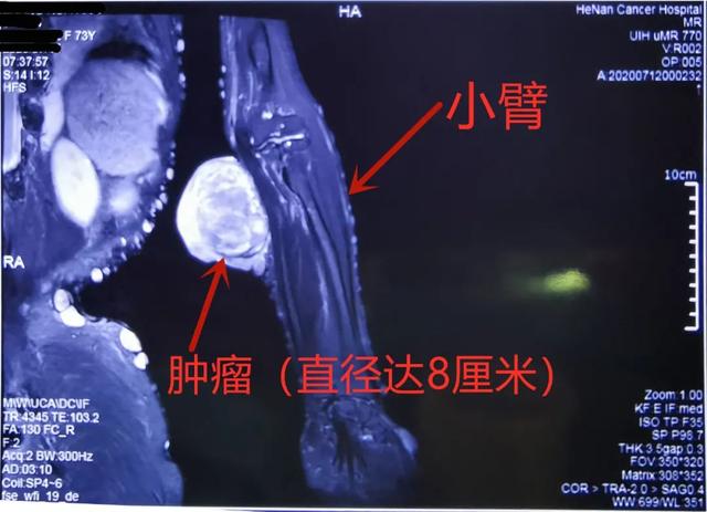 身上长肉疙瘩图片，身上长肉疙瘩是什么回事（长了一身“肉疙瘩”差点截肢很可怕……良性病也要当心恶变）