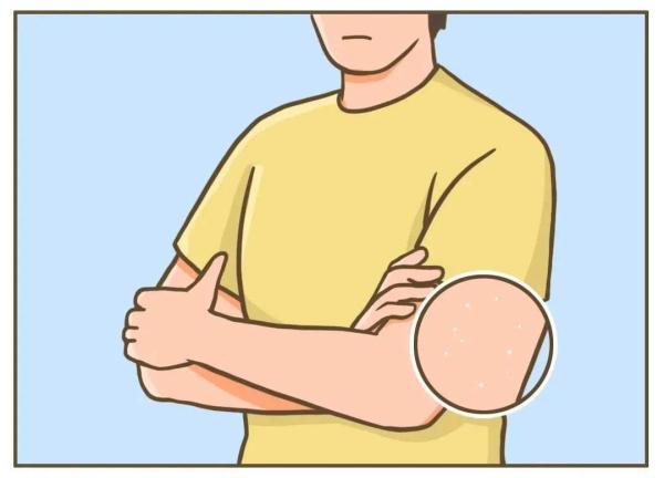 有头皮屑是什么原因引起的，很多头皮屑是什么原因（健康的人，会有头皮屑吗）