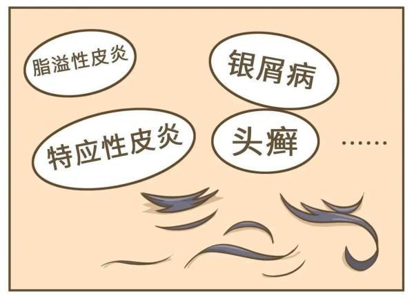 有头皮屑是什么原因引起的，很多头皮屑是什么原因（健康的人，会有头皮屑吗）