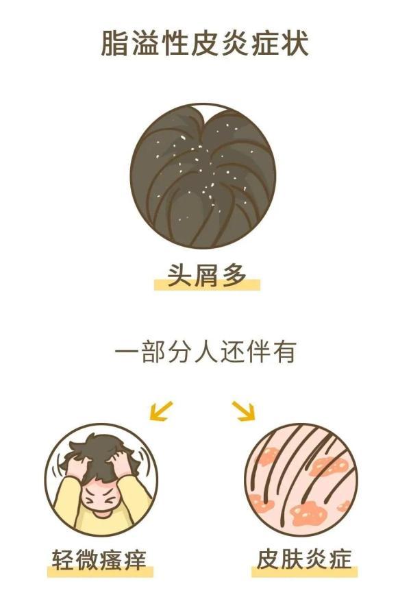 有头皮屑是什么原因引起的，很多头皮屑是什么原因（健康的人，会有头皮屑吗）