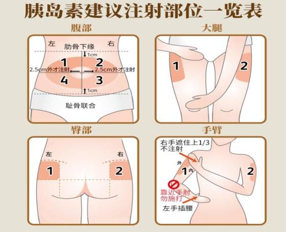 胰岛素怎么打正确方法，胰岛素怎么打最合适（怎样正确注射胰岛素）