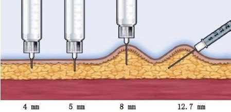 胰岛素怎么打正确方法,胰岛素怎么打最合适(怎样正确注射胰岛素)