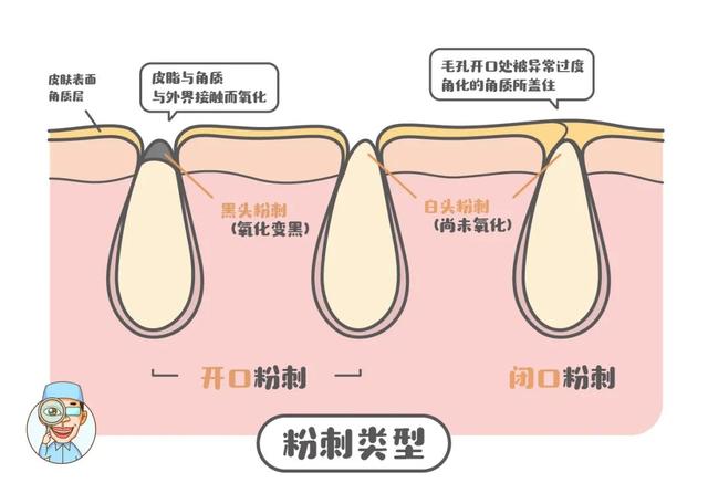 毛孔堵塞什么样子的图片，脸上毛孔堵塞症状（油皮必看：手把手教你消灭闭口）