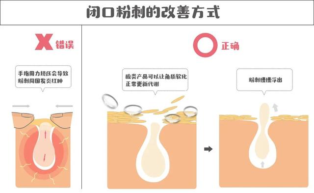 毛孔堵塞什么样子的图片，脸上毛孔堵塞症状（油皮必看：手把手教你消灭闭口）