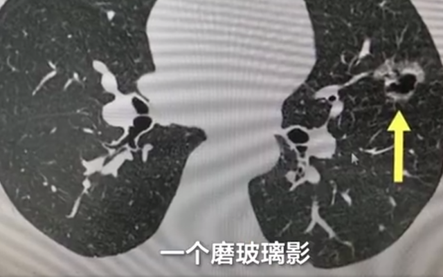 女性长期呆在二手烟环境，女人吸二手烟易得什么病（女子长期吸同事二手烟肺部长肿块）